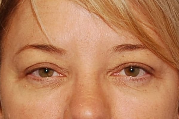Upper Eyelid Lift Patient Photo - Case 3867 - after view