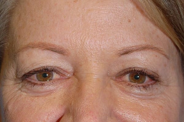 Lower Eyelid Lift/Pinch - Case 3877 - Before