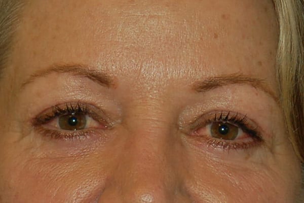 Lower Eyelid Lift/Pinch Patient Photo - Case 3877 - after view