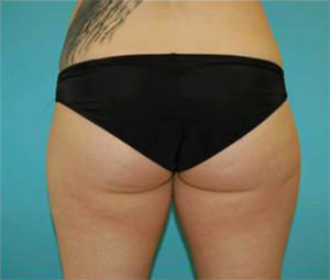 Before Coolsculpting San Clemente Orange County