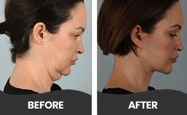 Before & After Facial liposuction Aliso Viejo”