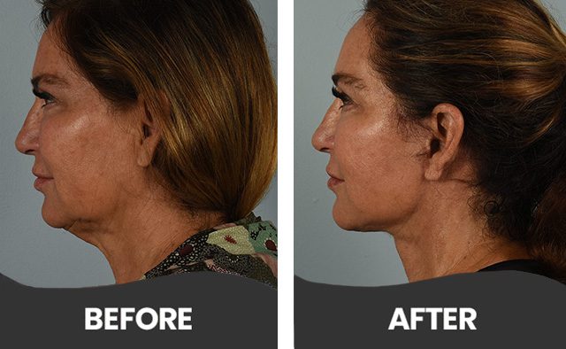Before & After Neck Lift Aliso Viejo
