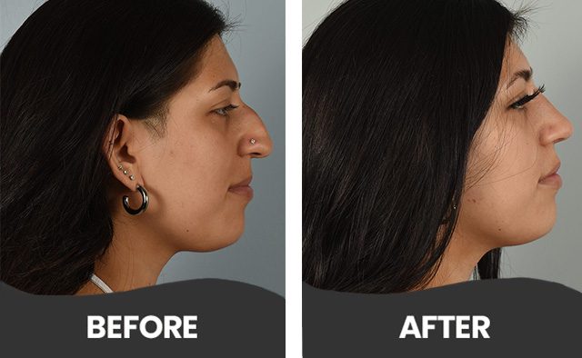 Before & After Nose Job Aliso Viejo