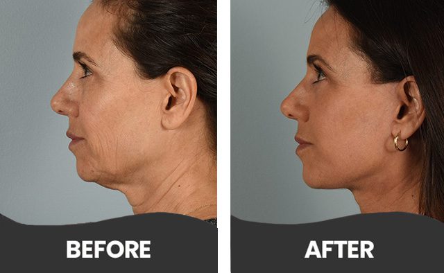 Before & After Facial Plastic Surgery Aliso Viejo