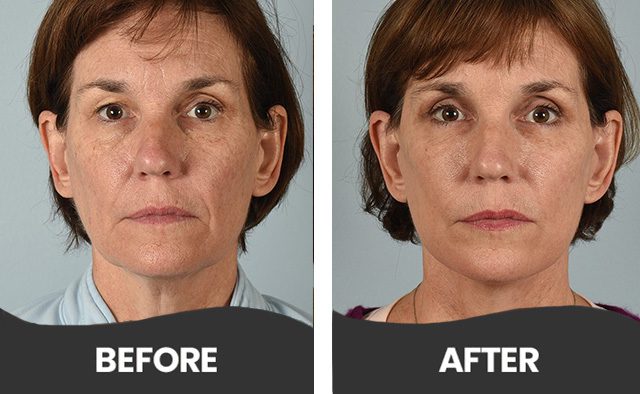 Before & After Botox Treatment Aliso Viejo