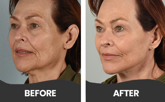 Before & After Facelift Aliso Viejo