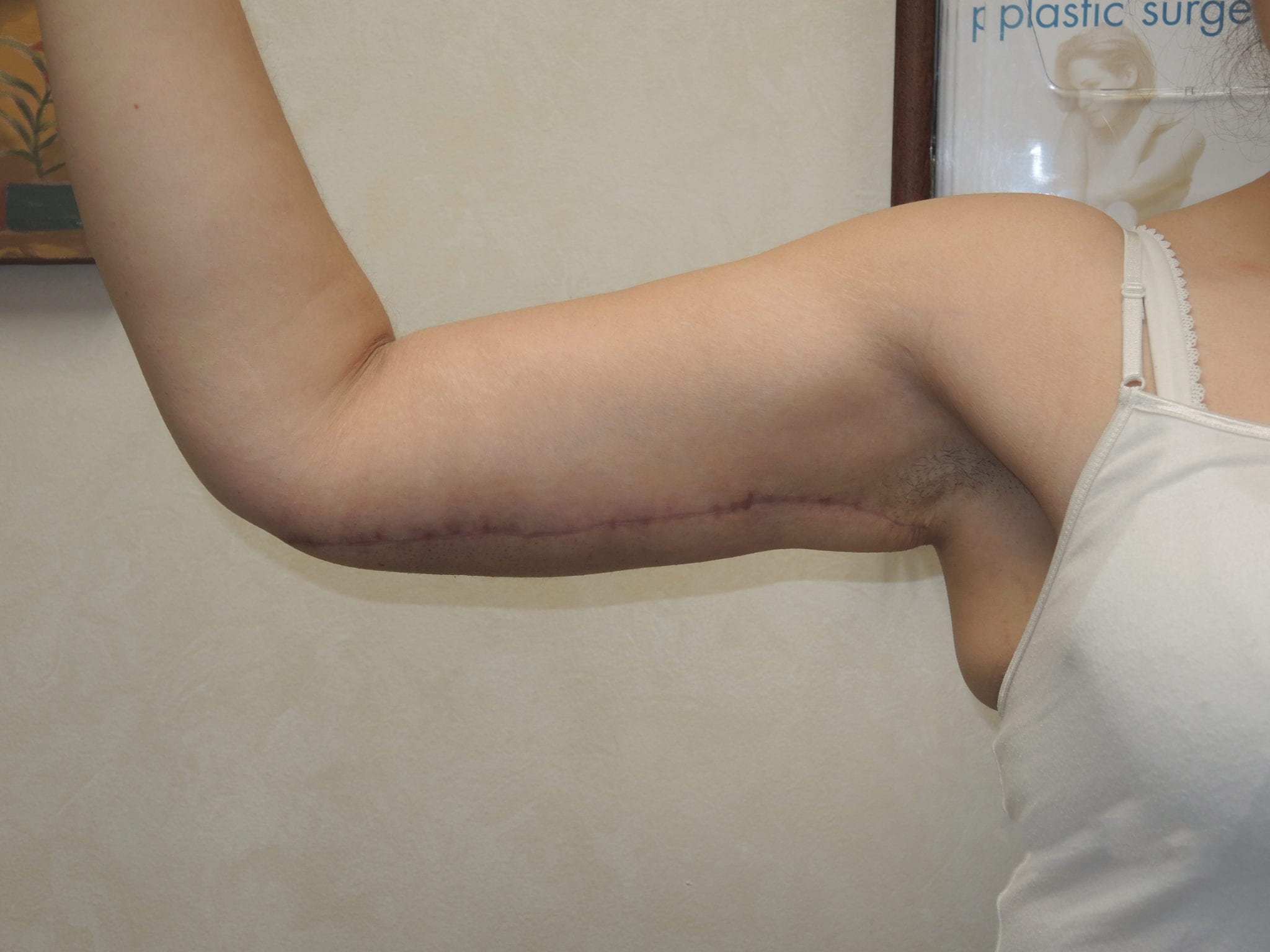 Arm Lift Patient Photo - Case 2440 - after view-0