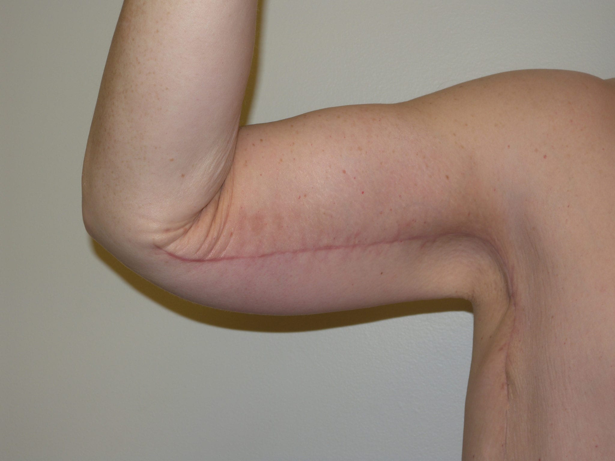 Arm Lift Patient Photo - Case 2501 - after view