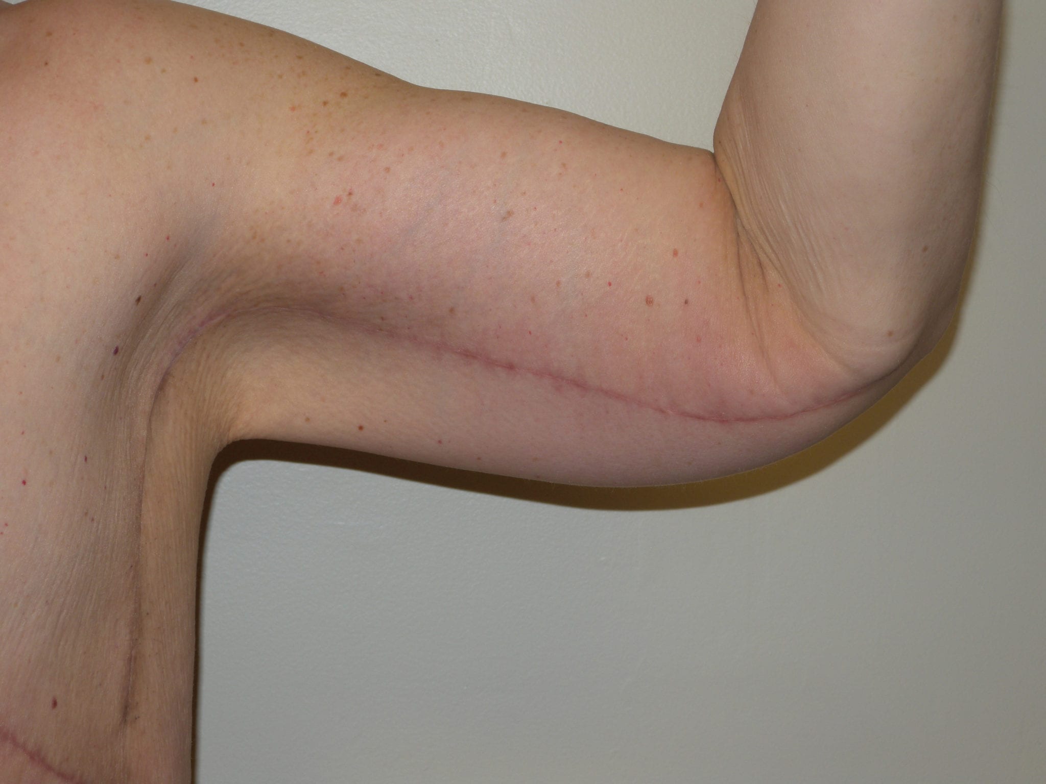 Arm Lift Patient Photo - Case 2501 - after view-1