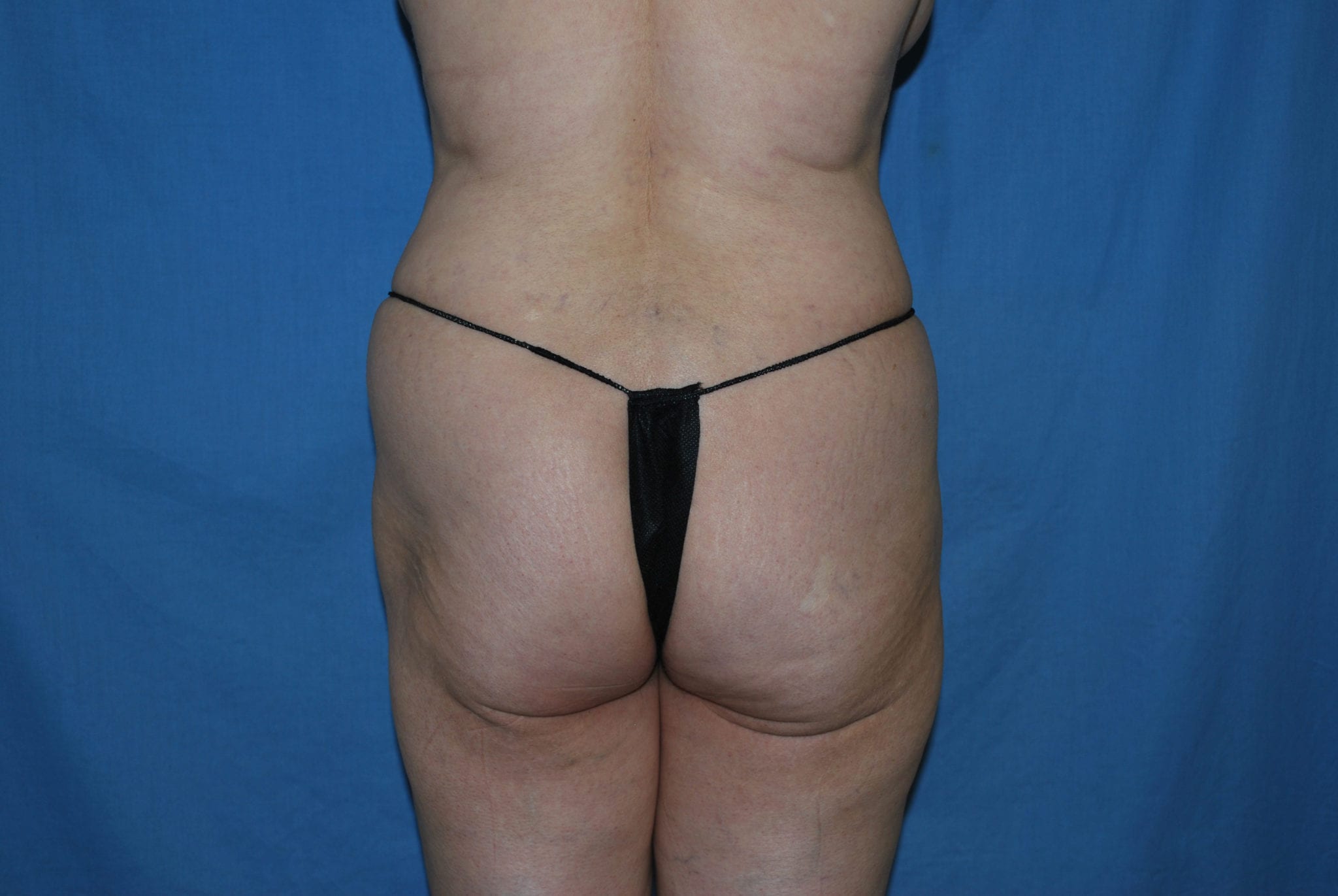 Booty Boost Patient Photo - Case 2969 - before view-0