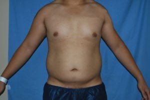 Liposuction in Aliso Viejo Orange County, Ca - Before 1a