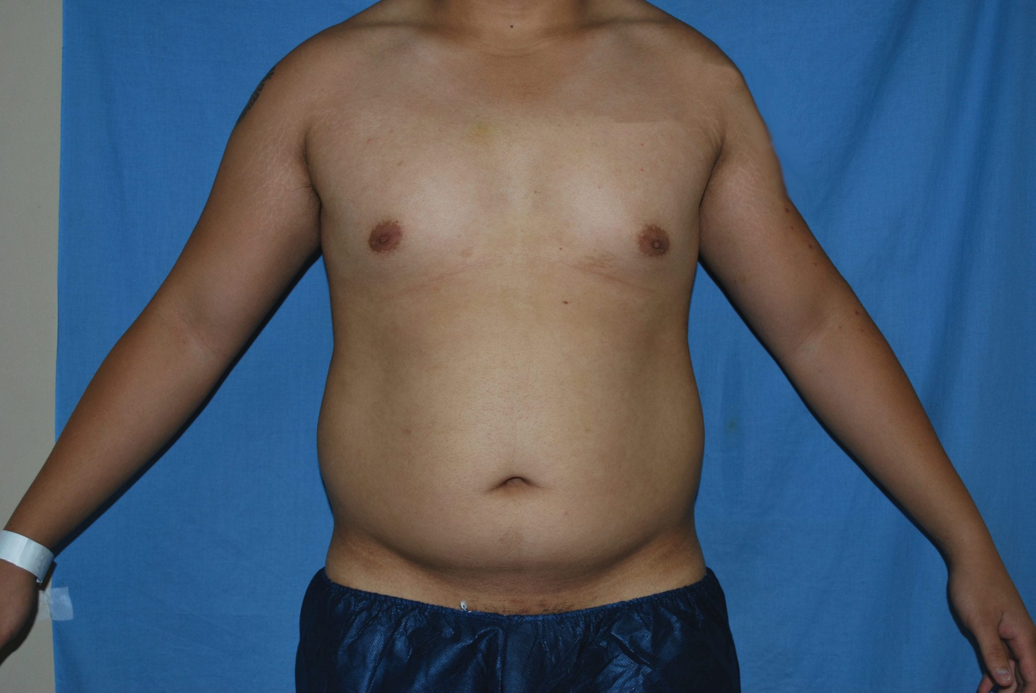 Liposuction Patient Photo - Case 3546 - before view-0