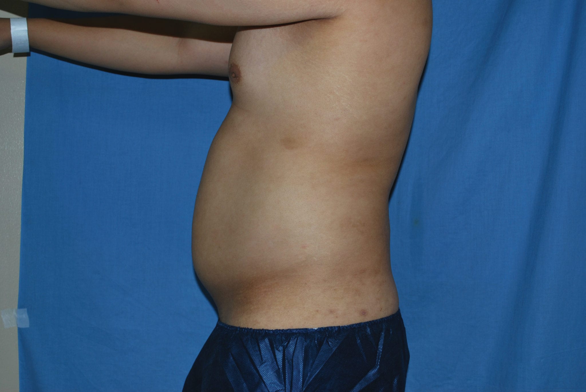 Liposuction Patient Photo - Case 3546 - before view-1