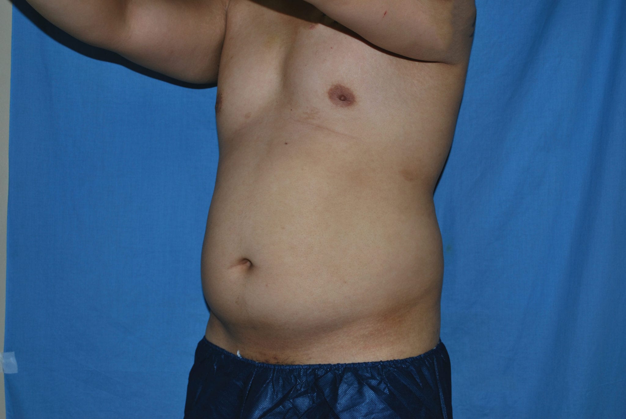 Liposuction Patient Photo - Case 3546 - before view-2