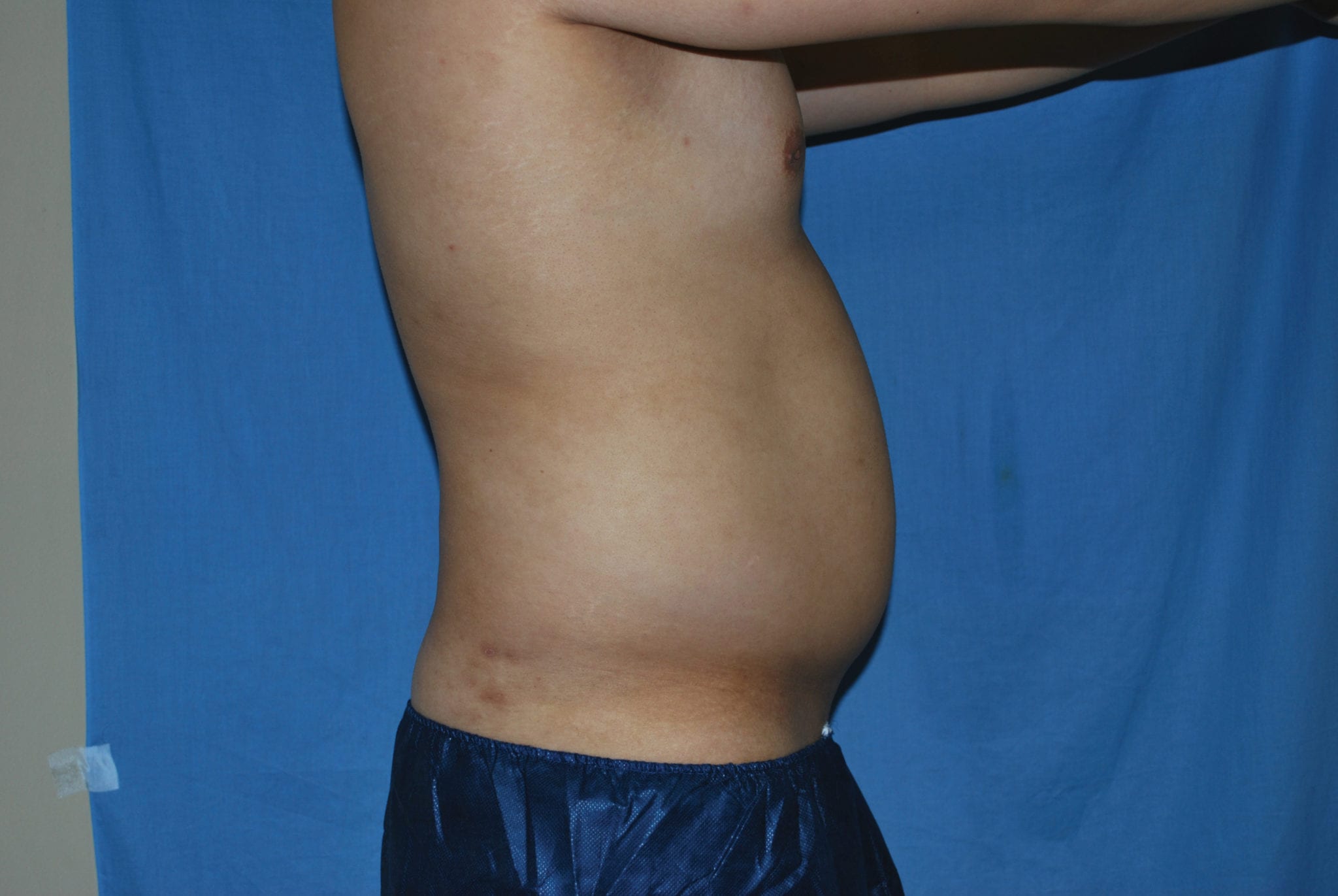 Liposuction Patient Photo - Case 3546 - before view-3