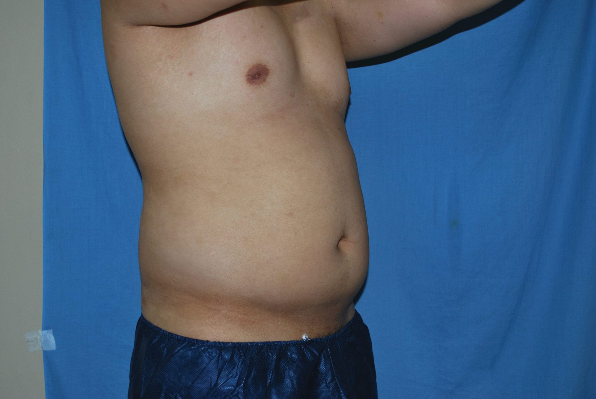 Liposuction Patient Photo - Case 3546 - before view-4