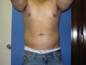 Liposuction in Aliso Viejo Orange County, Ca - After 1b