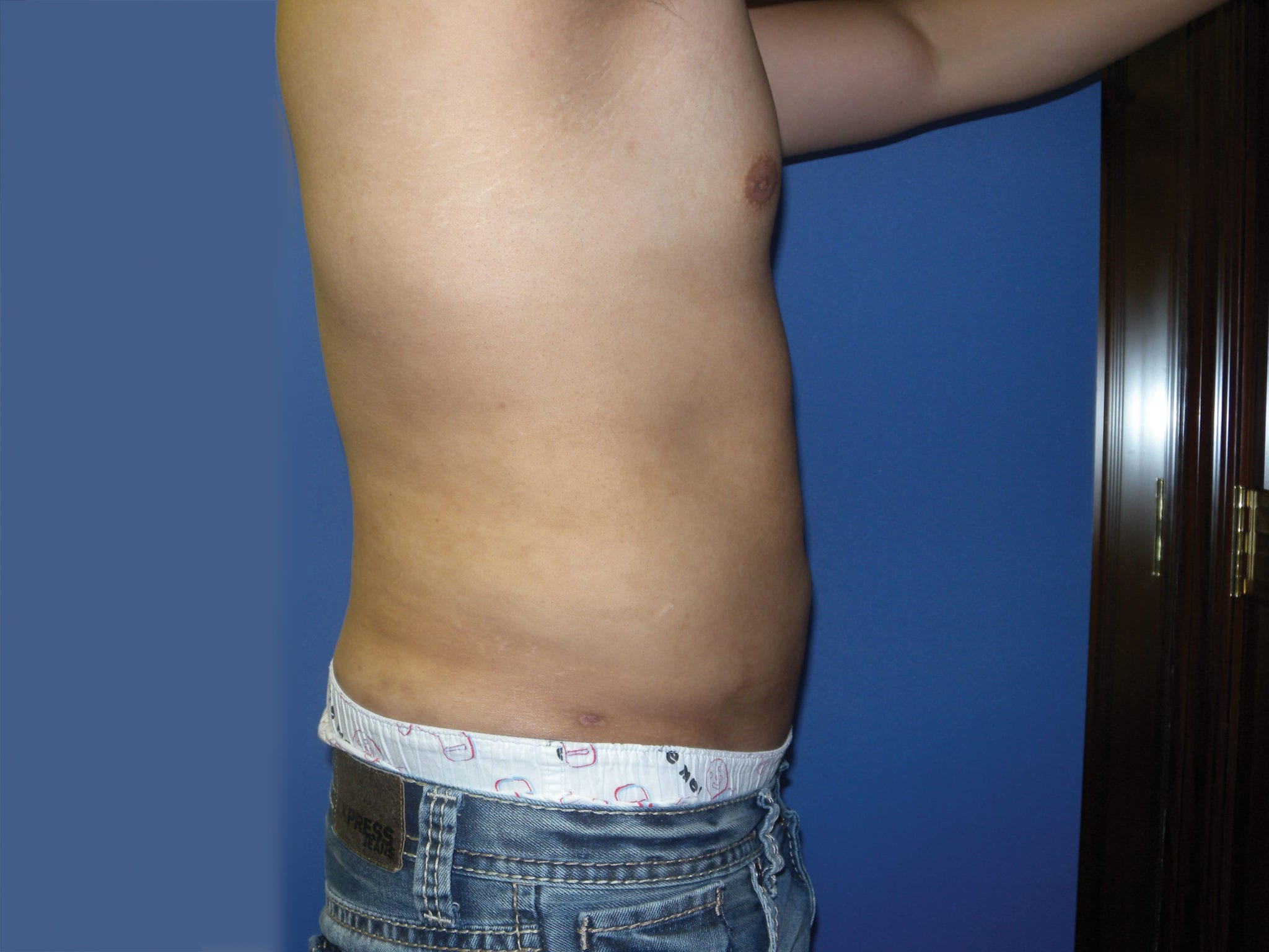 Liposuction Patient Photo - Case 3546 - after view-3