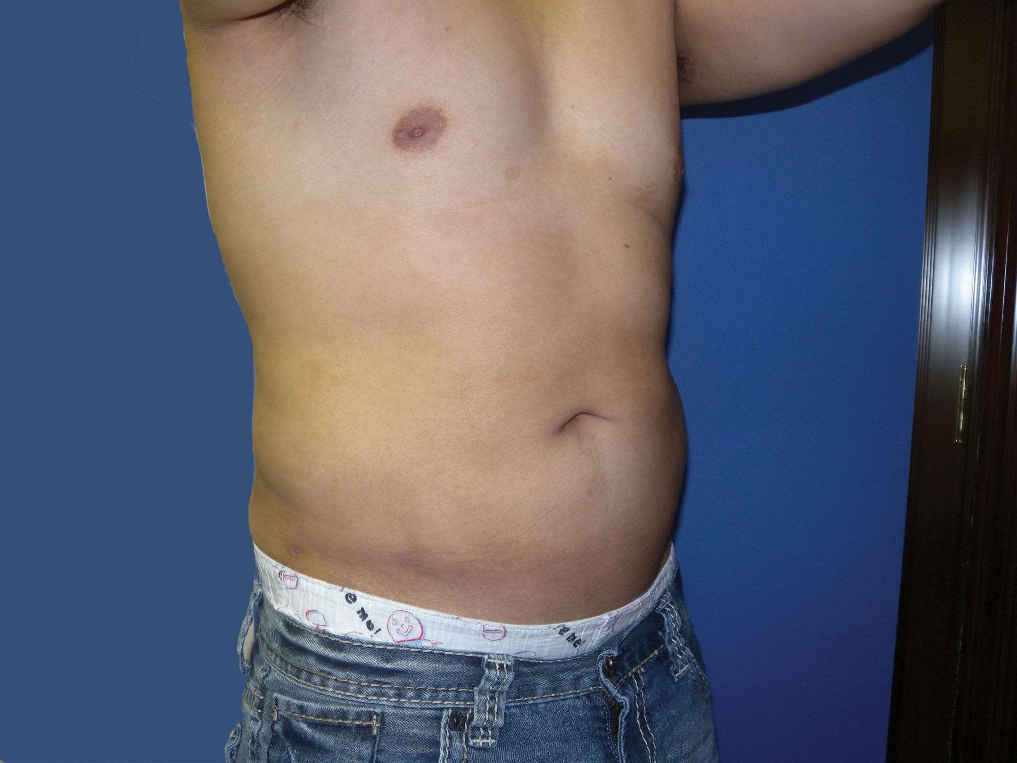 Liposuction Patient Photo - Case 3546 - after view-4