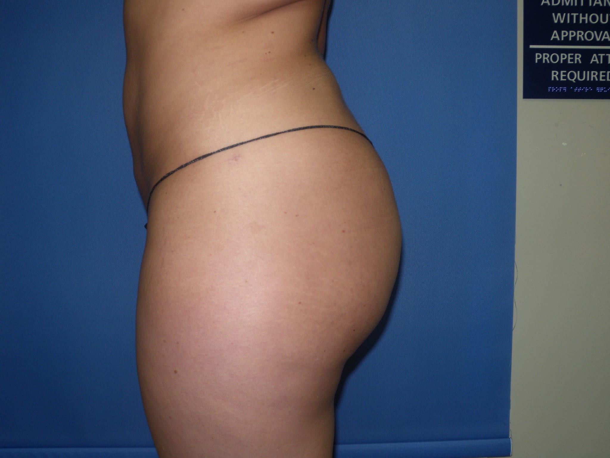 Booty Boost Patient Photo - Case 2977 - after view-0
