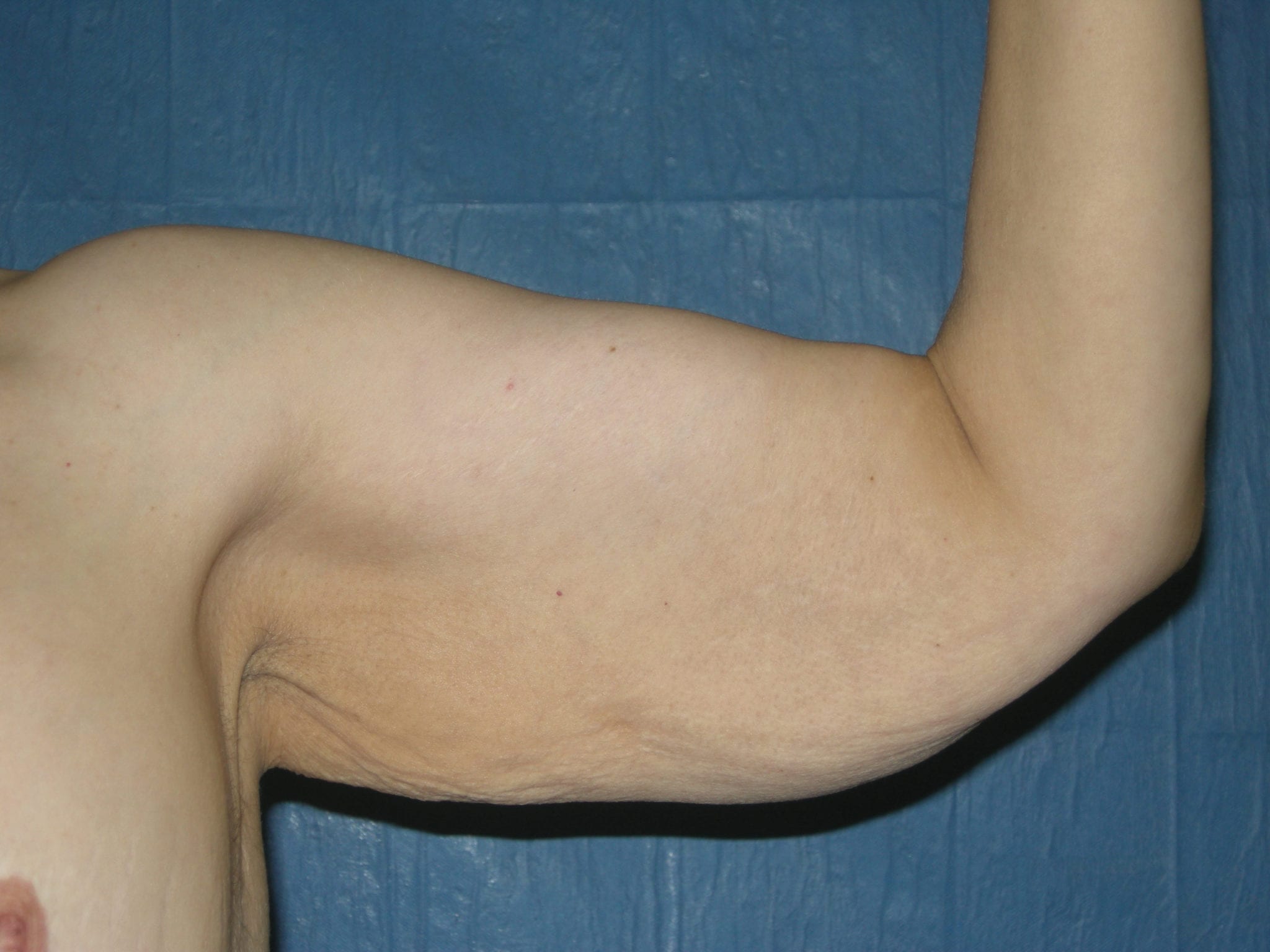 Arm Lift Patient Photo - Case 2506 - before view-1