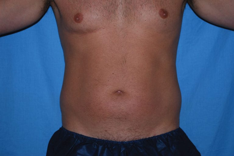 Liposuction - Case 3557 - Before