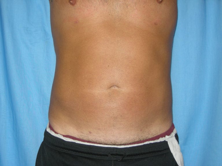Liposuction - Case 3557 - After
