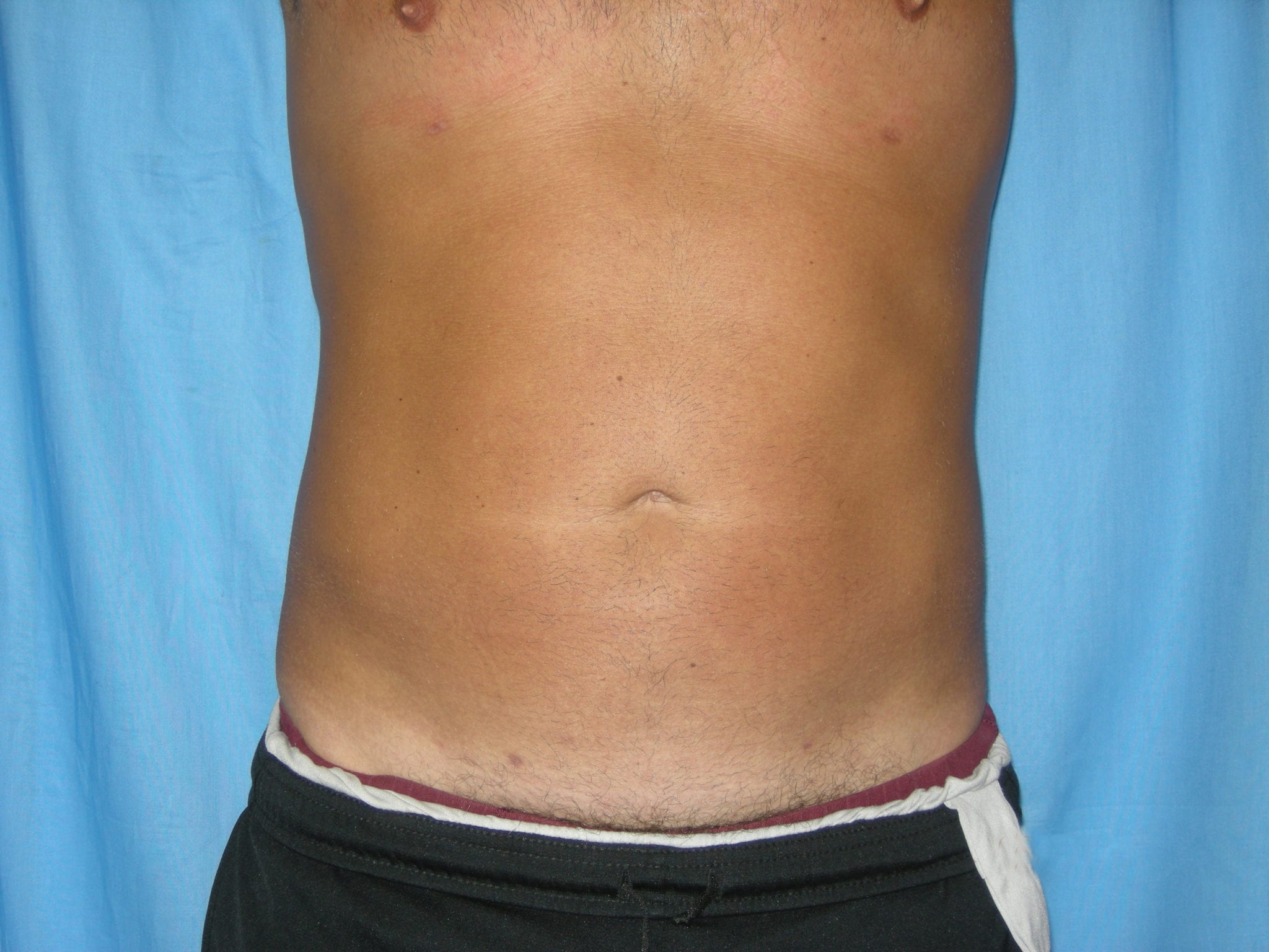 Liposuction Patient Photo - Case 3557 - after view