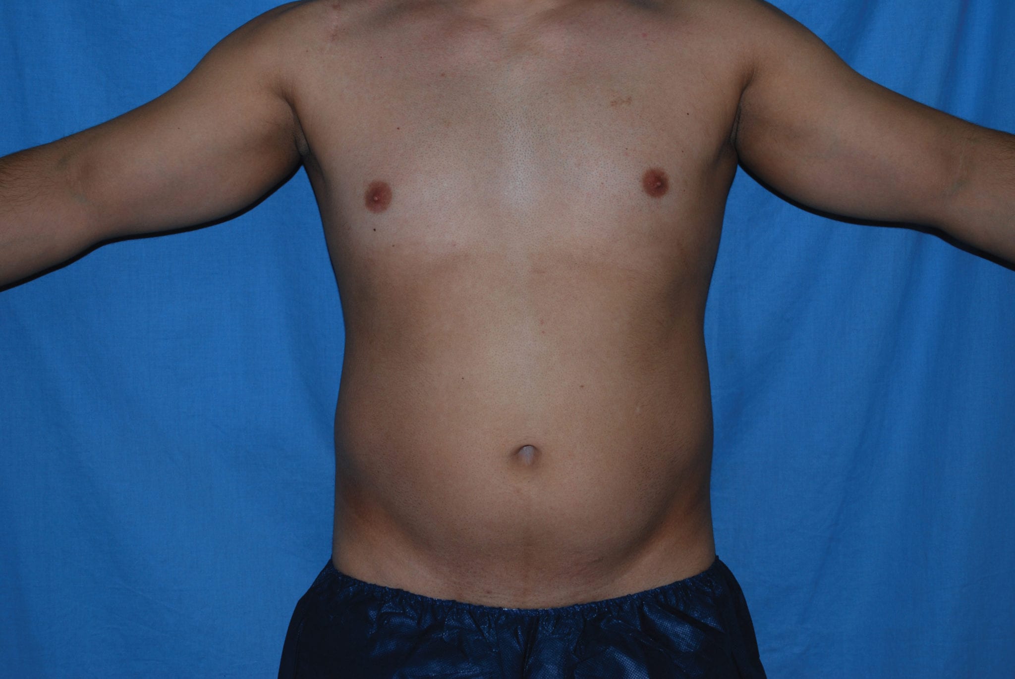 Liposuction Patient Photo - Case 3537 - before view-