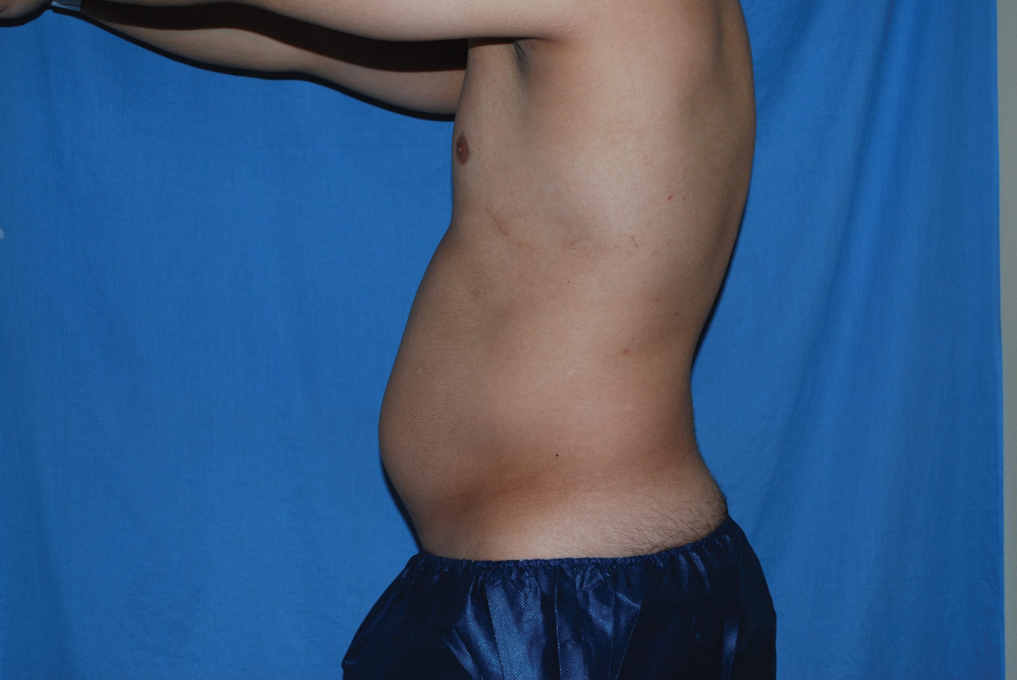Liposuction Patient Photo - Case 3537 - before view-1