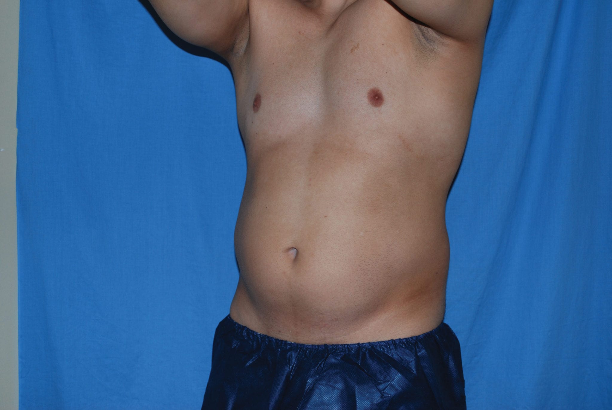 Liposuction Patient Photo - Case 3537 - before view-2