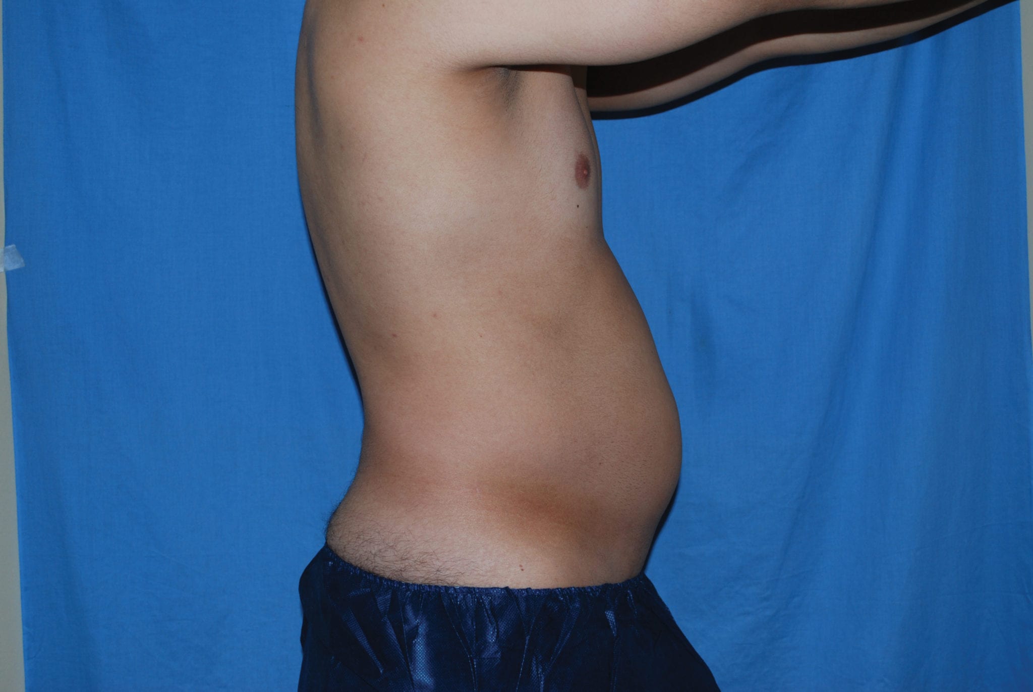 Liposuction Patient Photo - Case 3537 - after view-2