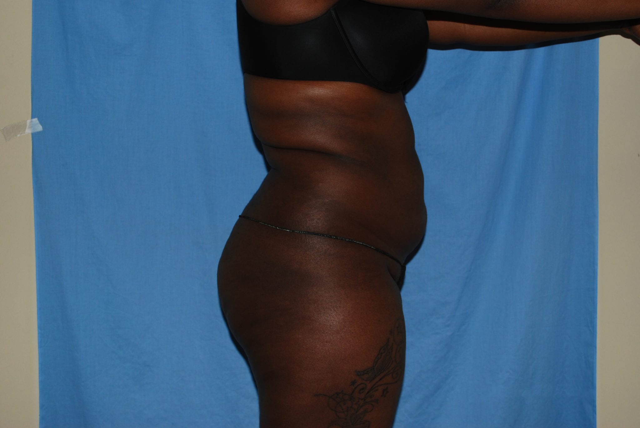 Booty Boost Patient Photo - Case 2982 - before view-1