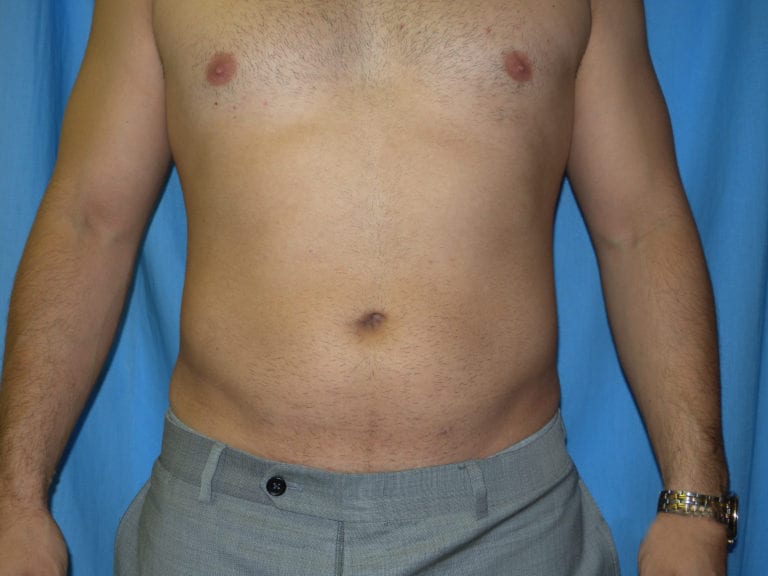 Liposuction - Case 3537 - After