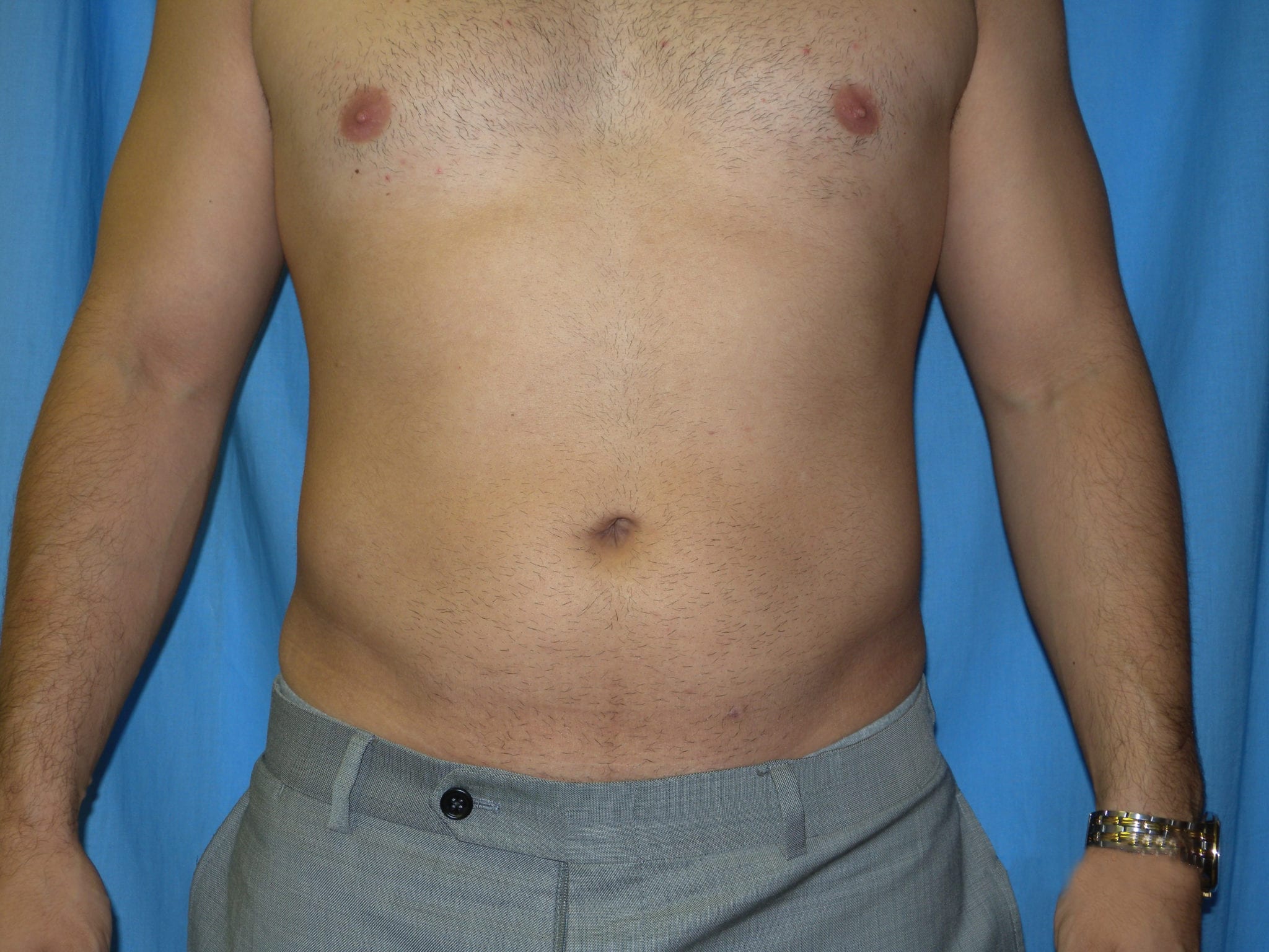 Liposuction Patient Photo - Case 3537 - after view
