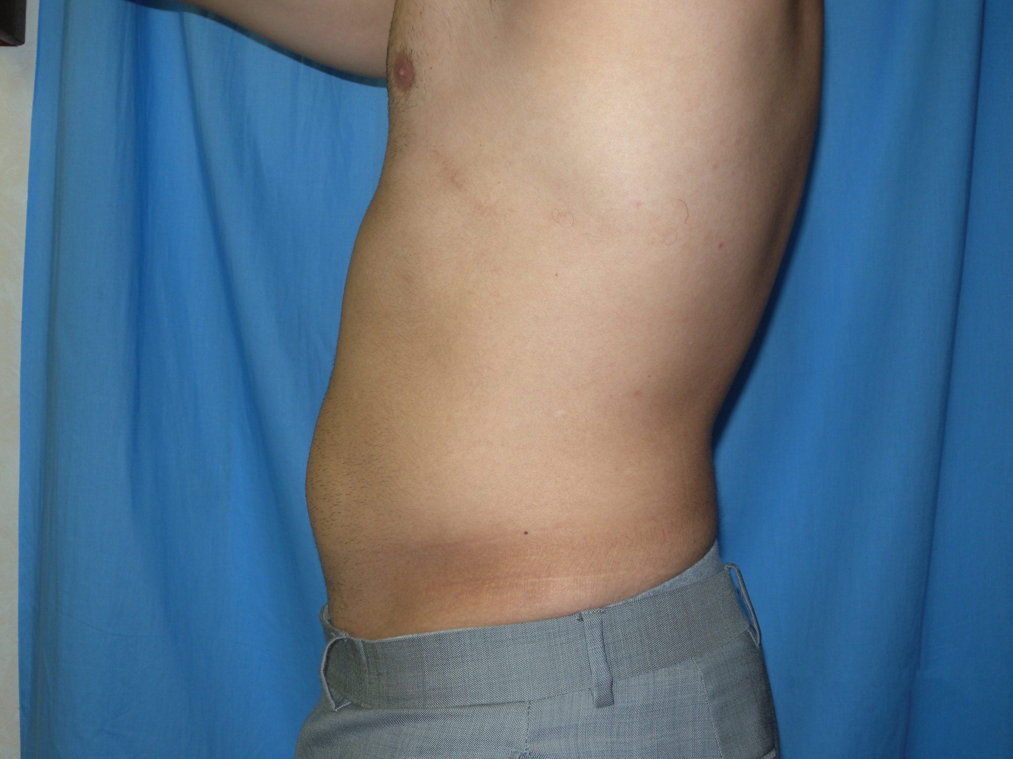 Liposuction Patient Photo - Case 3537 - after view-1