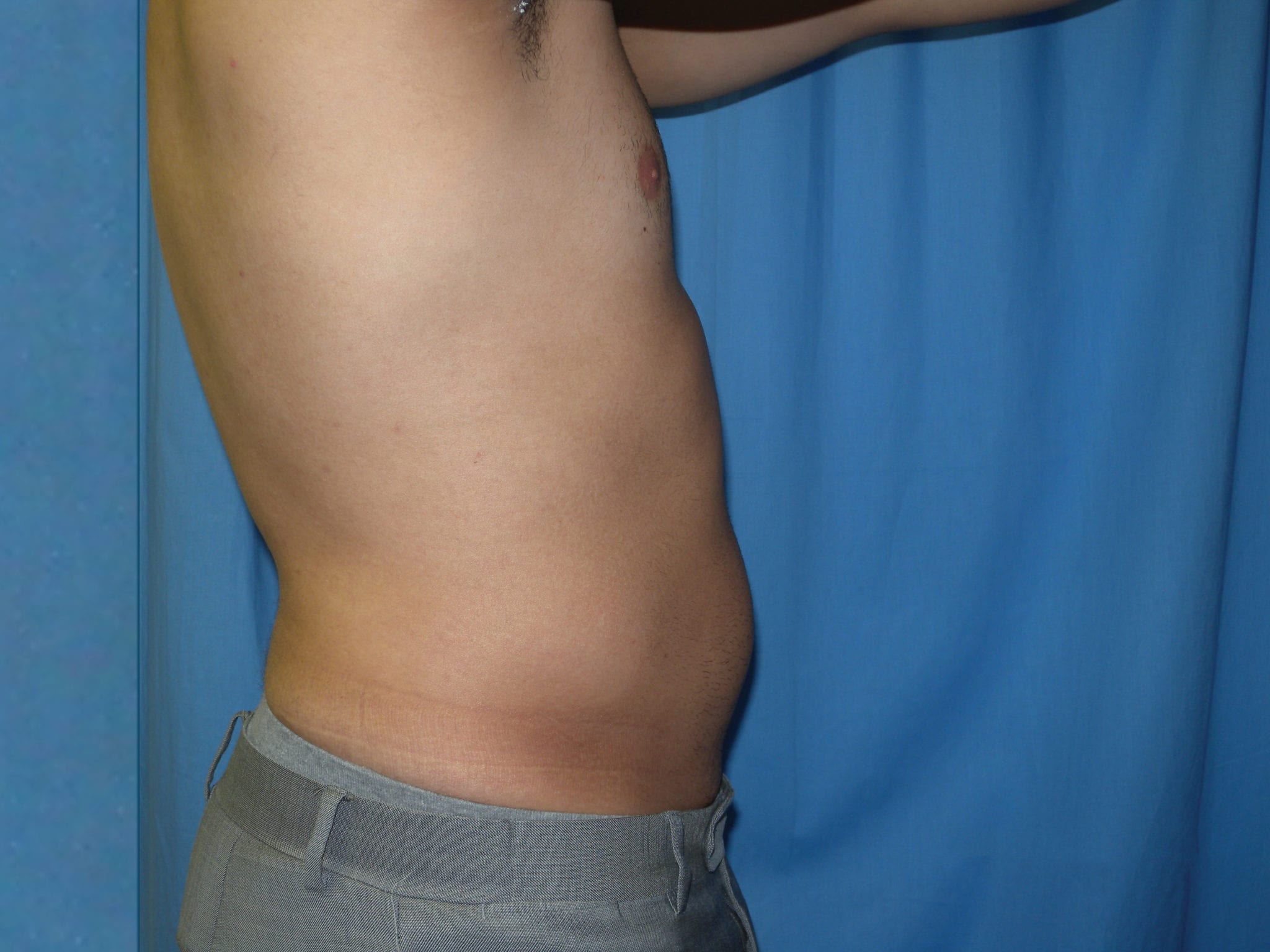 Liposuction Patient Photo - Case 3537 - after view-3