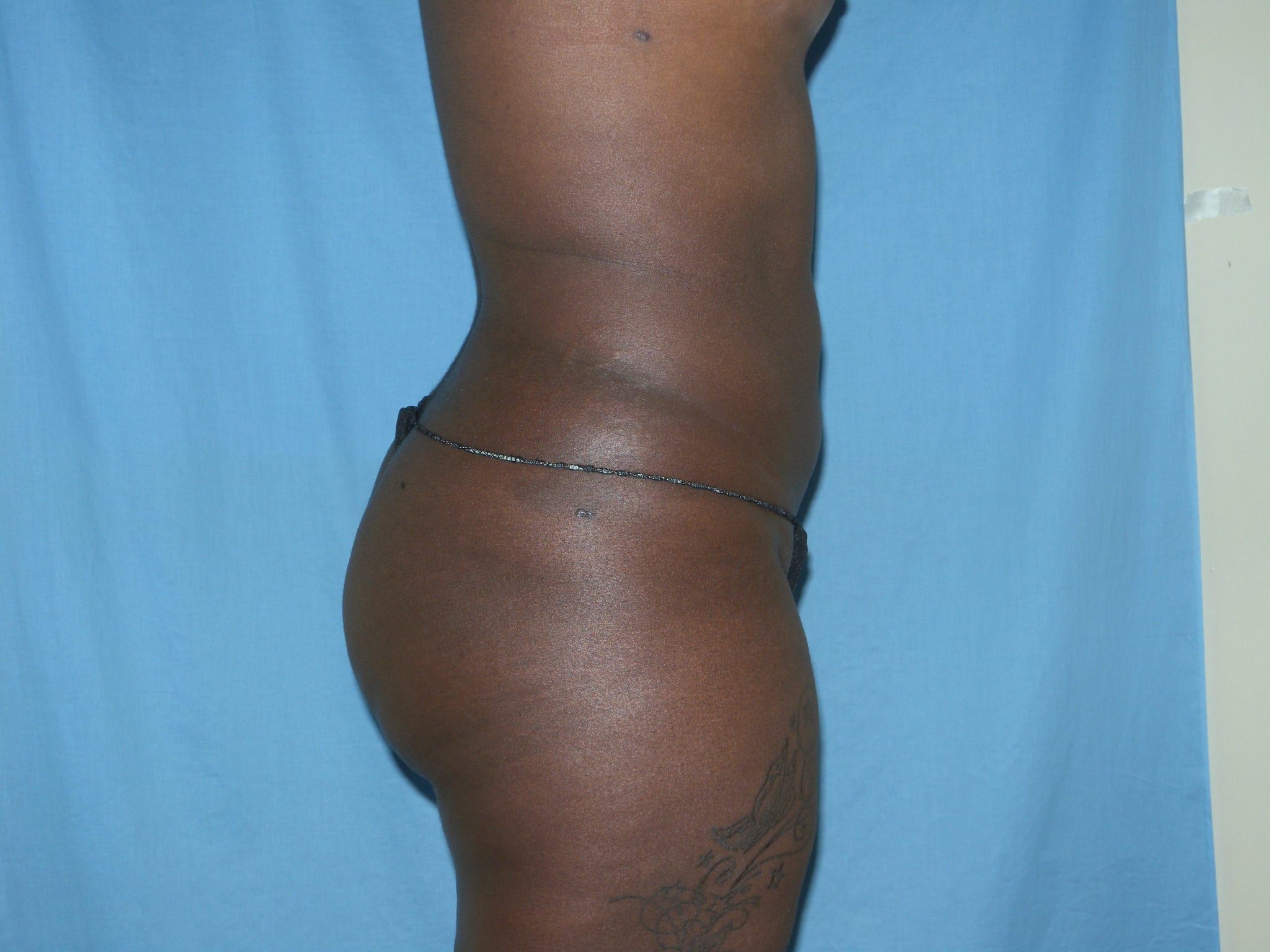 Booty Boost Patient Photo - Case 2982 - after view-1