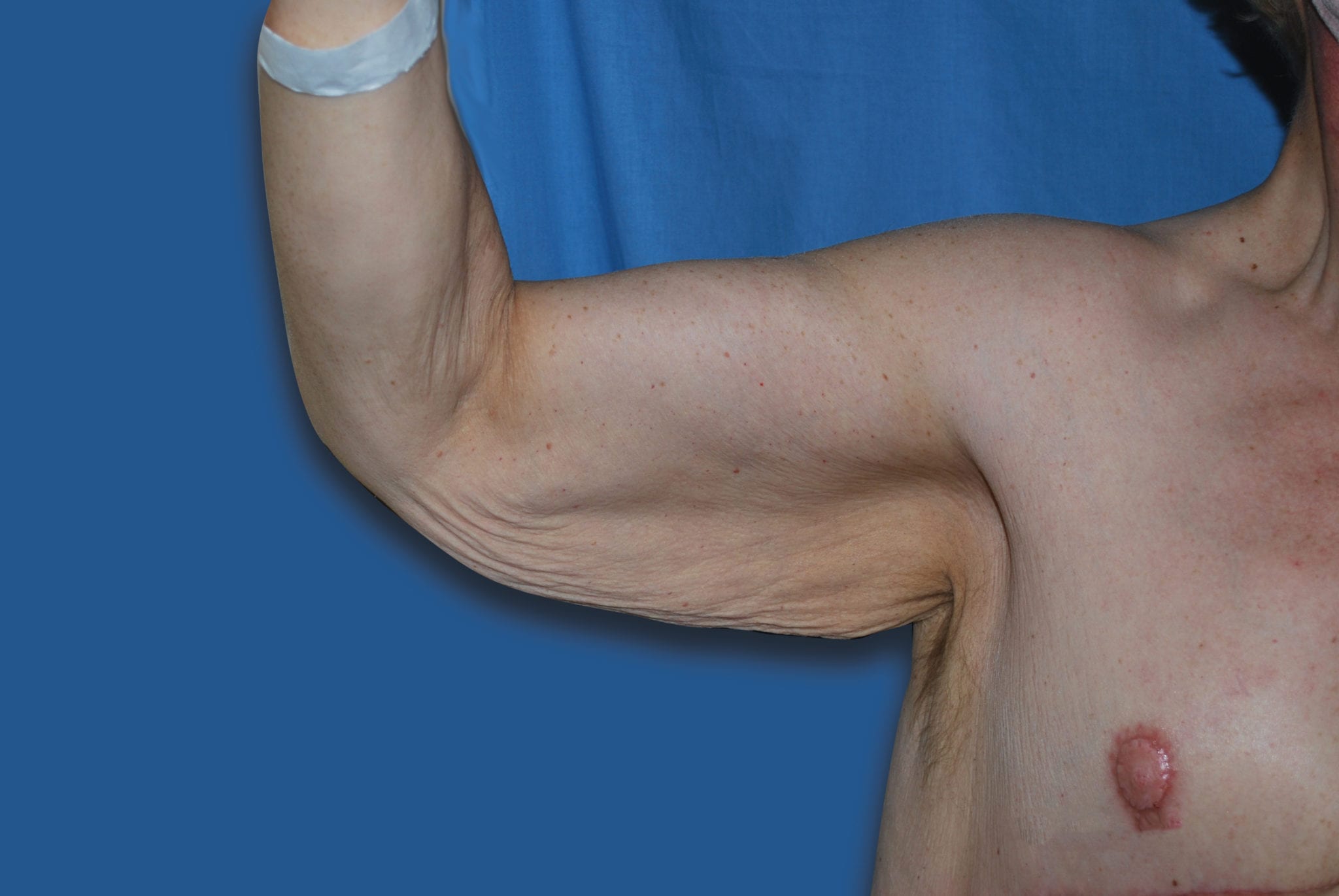Arm Lift Patient Photo - Case 2501 - before view-0