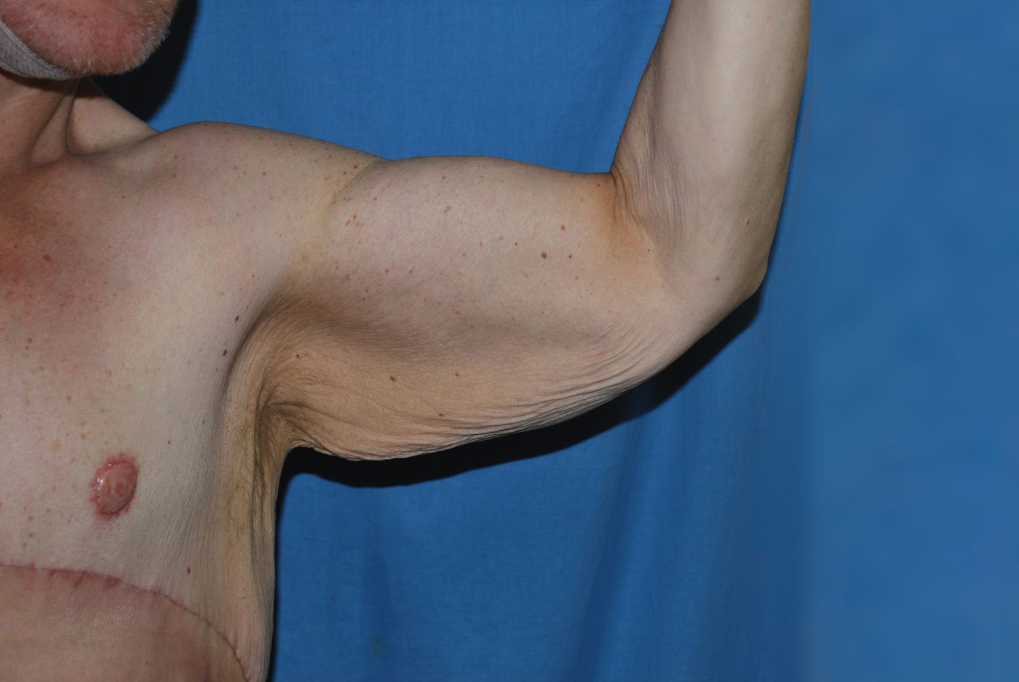 Arm Lift Patient Photo - Case 2501 - before view-1