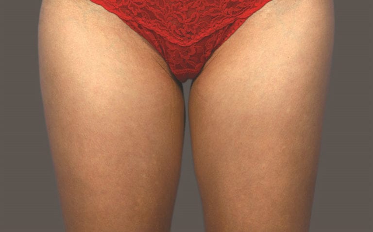 CoolSculpting - Case 4132 - Before