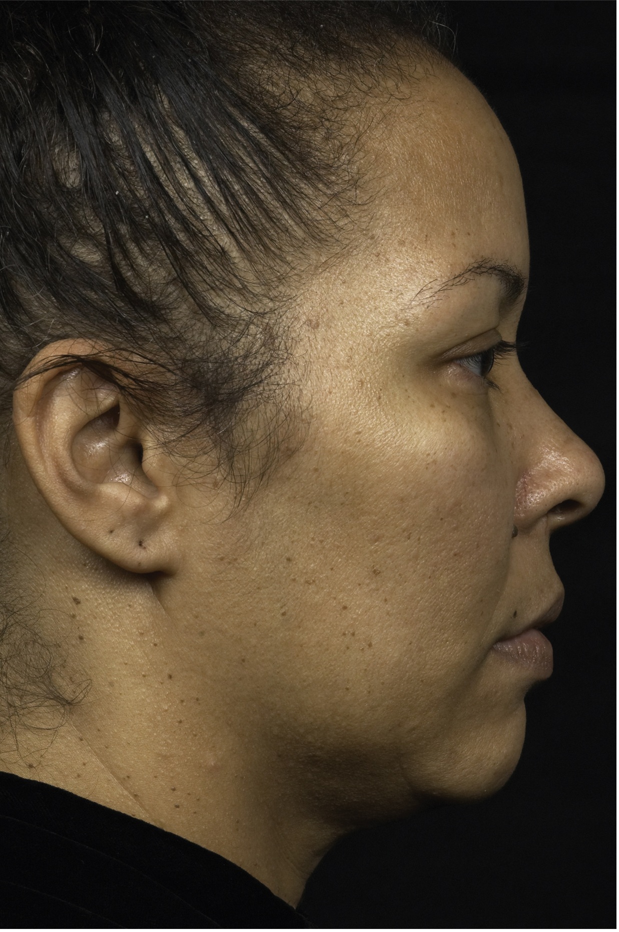 Thermage Patient Photo - Case 5401 - before view-