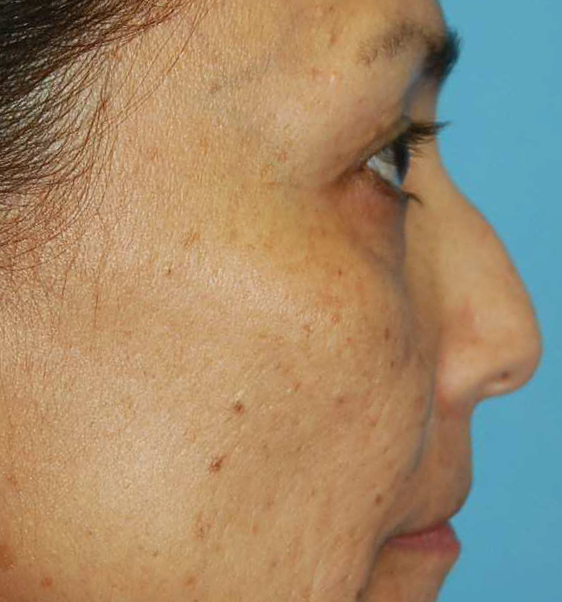 Rhinoplasty Patient Photo - Case 5364 - before view-