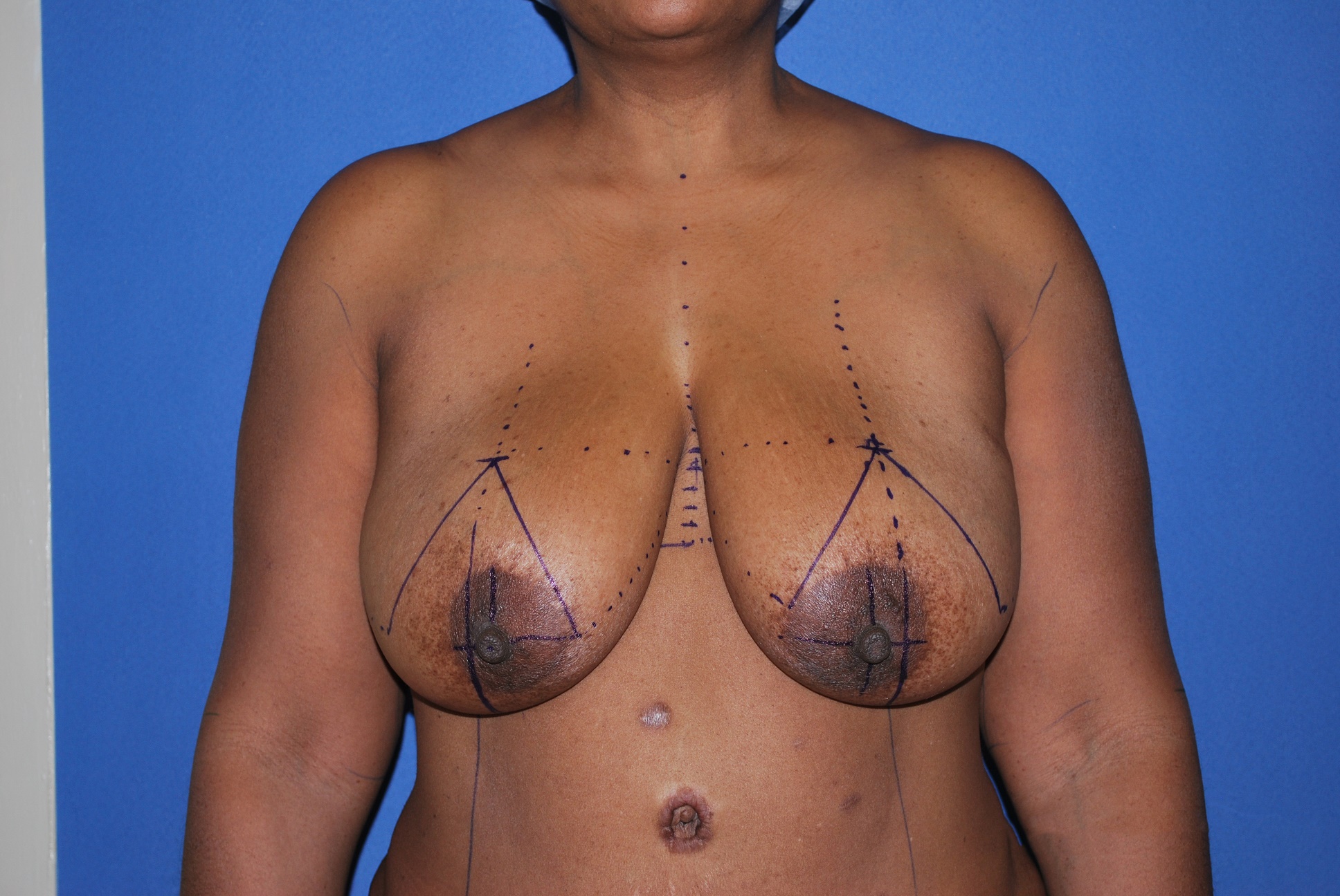 Breast Reduction Patient Photo - Case 4617 - before view-0