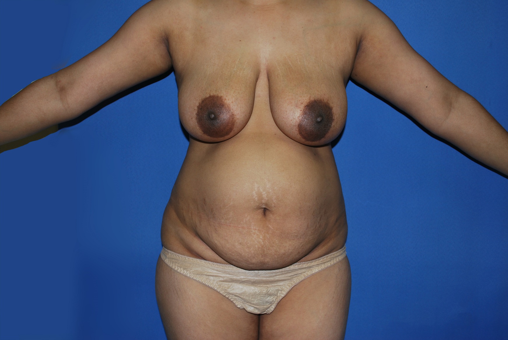 Mommy Makeover Patient Photo - Case 4668 - before view-0