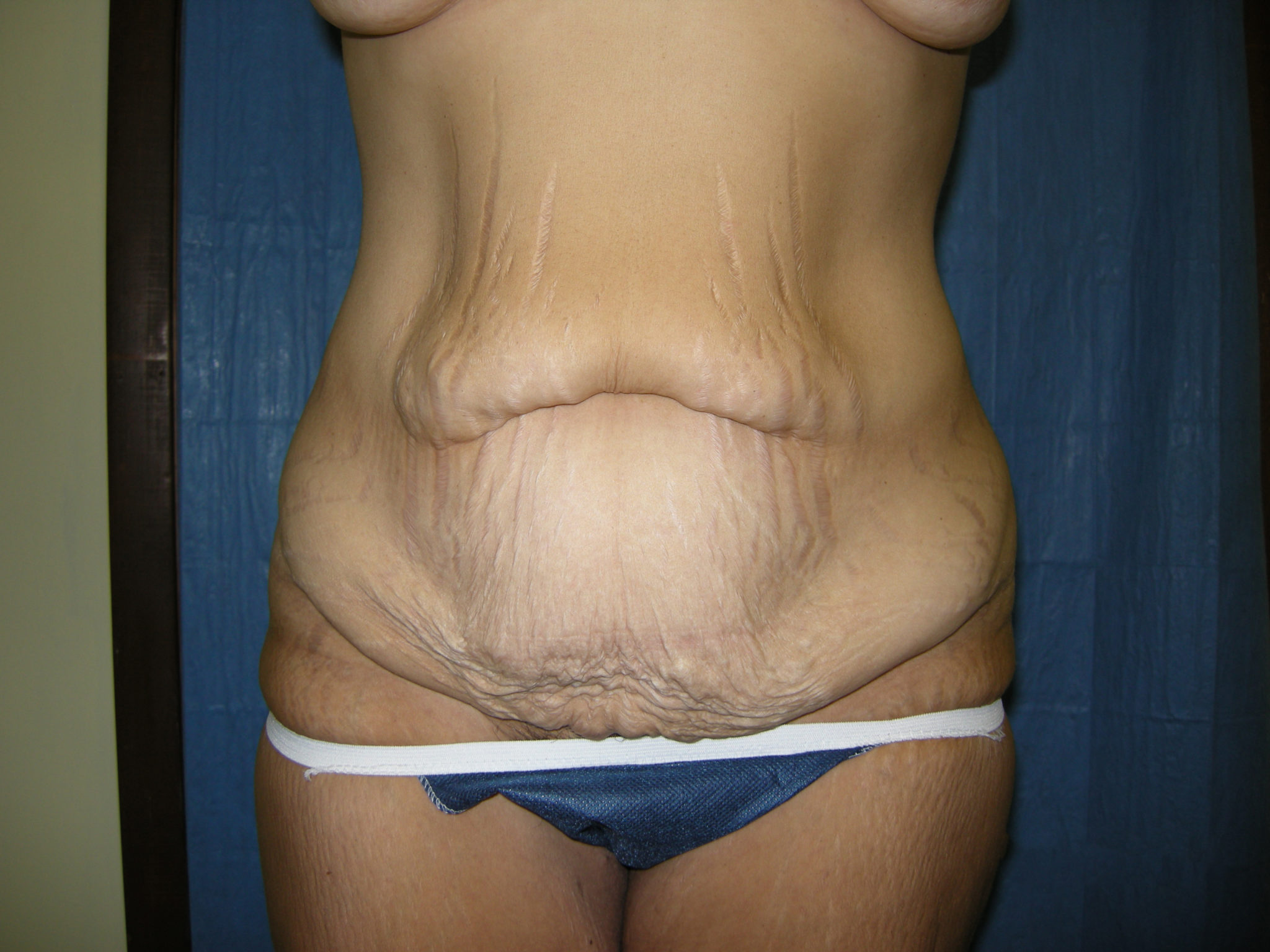 Tummy Tuck Patient Photo - Case 3343 - before view-0