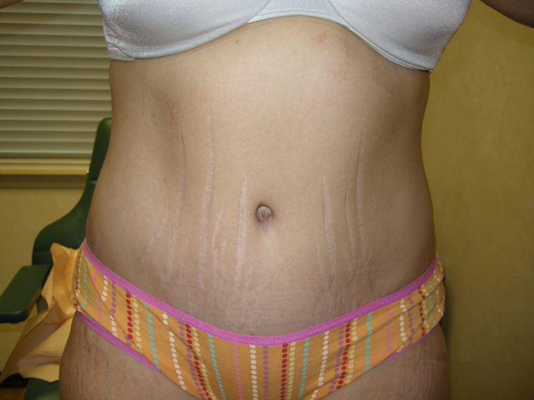 Tummy Tuck - Case 3343 - After