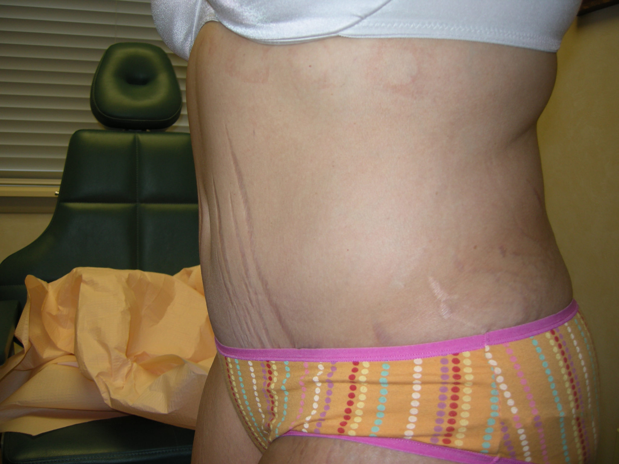 Tummy Tuck Patient Photo - Case 3343 - after view-1