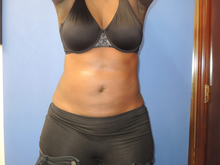Liposuction - Case 3266 - After