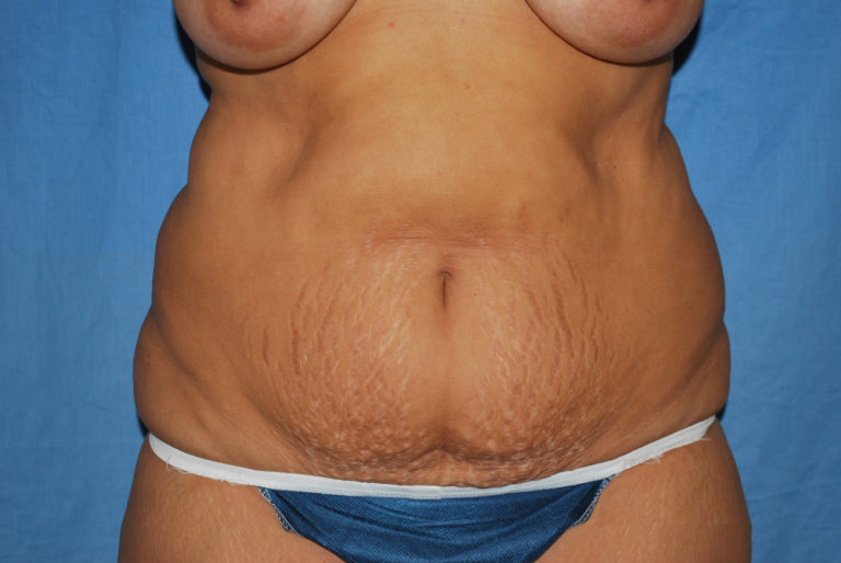 Liposuction - Case 3405 - Before